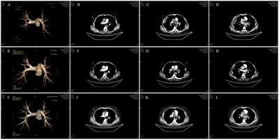 Pulmonary thromboembolism: a case report and misdiagnosis analysis of a 63-year-old female patient